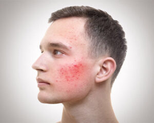 natural+treatments+for+acne1.jpg  