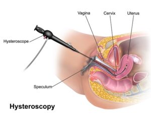 website-hysteroscopy-image-2017.jpg  
