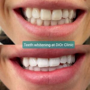 Teeth Whitening.jpg  