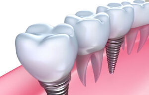 dental implants - no gap dentists - sydney.jpg  
