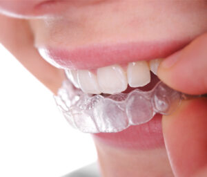 invisible braces - no gap dentists - sydney.jpg  